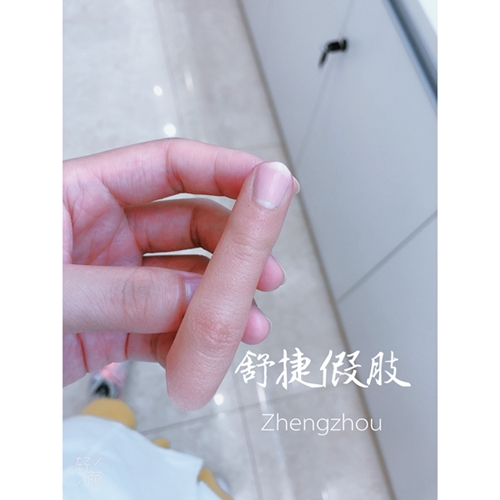 安裝假手指的接口如何處理比較好？
